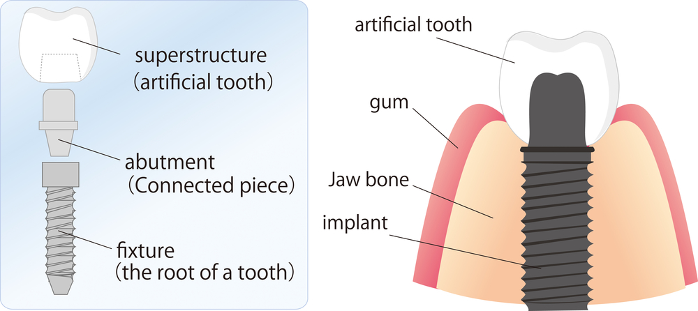 a diagram of how a dental implant works