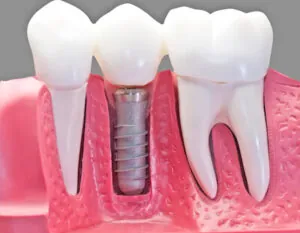 model showing how a dental implant works